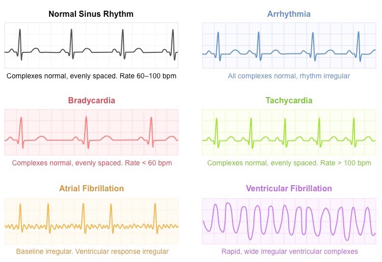 Assorted ECG rhythm examples